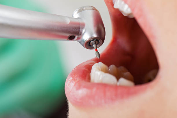 Best Dental Abscess Treatment in Atwater, CA